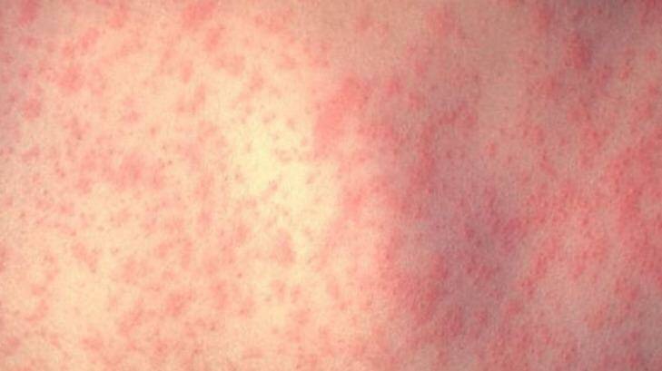 Three children have caught measles after being exposed to a infected child from a non-vaccinating family.  Photo: Centres for Disease Control and Prevention