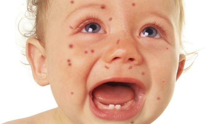 A baby boy with measles. Photo: istock